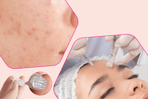 Combat Acne with Fractional Needling Therapy